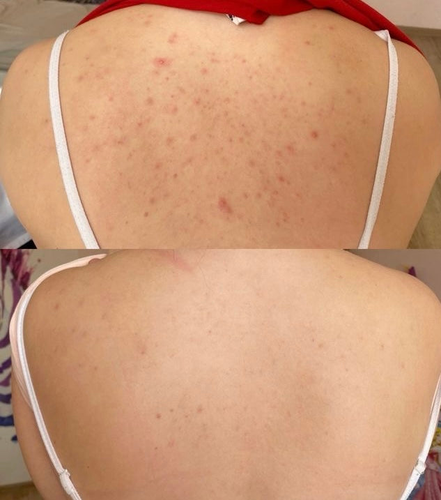NO ACNE BUNDLE